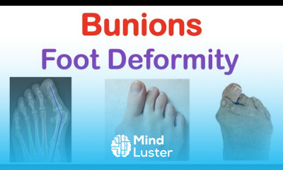 Bunions Foot Deformity Treatment