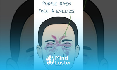 Polymyositis Treatment