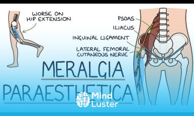 Meralgia Paraesthetica Diagnosis