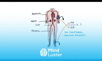 Abdominal Aortic Aneurysms Endovascular