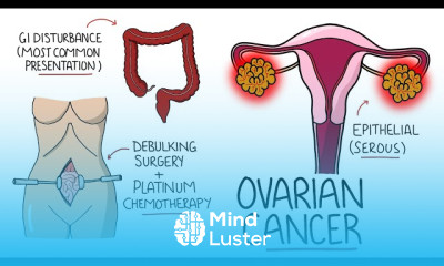 Ovarian Cancer Diagnosis