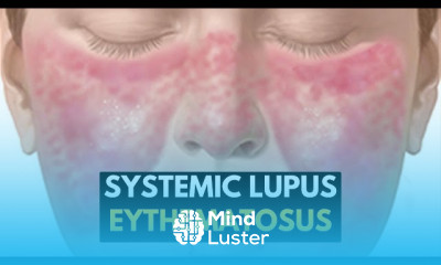 Systemic Lupus Eythematosus Symptoms
