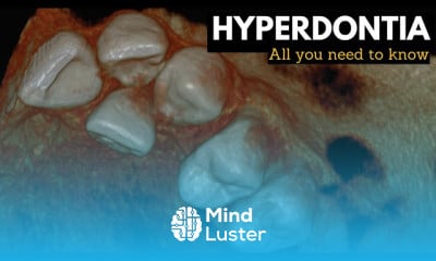 Wisdom teeth Symptoms and Treatment