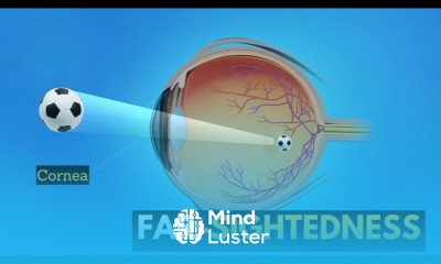 Macular degeneration Symptoms and Treatment