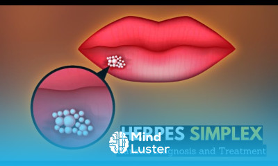 Herpes Simplex Symptoms and Treatment