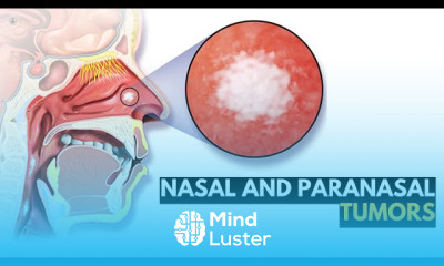 Pleural Effusion Symptoms and Treatment