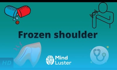 Calcific Bursitis Symptoms Treatment