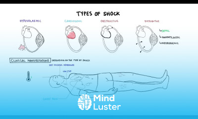 Subarachnoid Haemorrhage complications