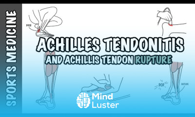 Iliotibial Band Syndrome rehabilitation