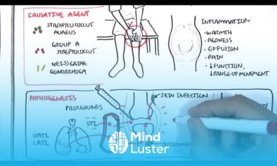 Septic Arthritis causes and treatment
