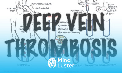 Deep Vein Thrombosis treatment