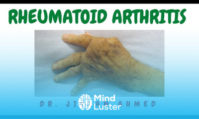 Muscular Dystrophy Complications