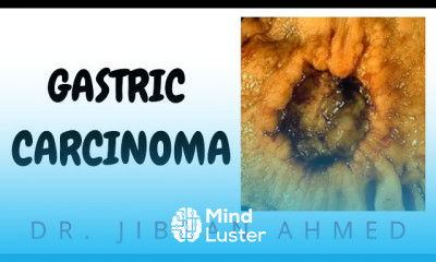 Gastric carcinoma treatment modalities