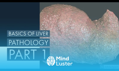 Hepatocellular Carcinoma Liver