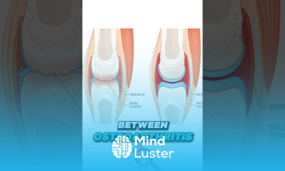 Rheumatoid Arthritis symptoms and diagnosis