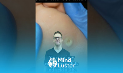 Acanthosis Nigricans symptoms and treatment