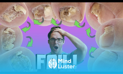 Toenail Fungus treatment at Home