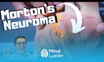 Mortons Neuroma massage exercises