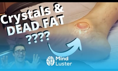 Foot Callus treatment