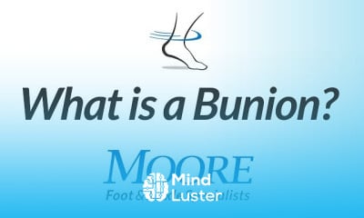 Bunion causes and treatment options