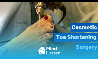 Hammertoe correction surgery techniques