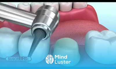 Dental drill techniques