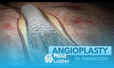 Aortic aneurysm Fundamentals
