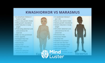KWASHIORKOR VS MARASMUS