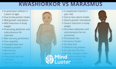 Kwashiorkar Vs Marasmus PEM Diseases