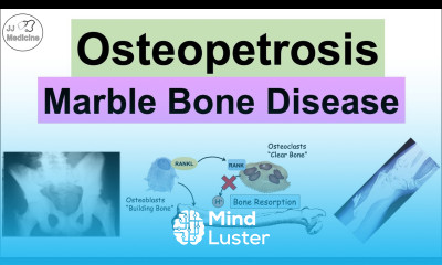 Osteopetrosis Marble Bone Disease Causes Symptoms Diagnosis Treatment