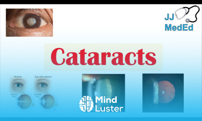 Cataracts Causes Risk factors Subtypes Cortical Nuclear Posterior subcapsular Treatment