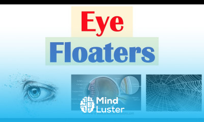 Eye Floaters Vitreous Floaters Causes Risk Factors Associated Conditions Diagnosis Treatment