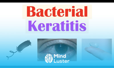 Bacterial Keratitis Eye Infection From Contact Lenses Causes Symptoms Diagnosis Treatment