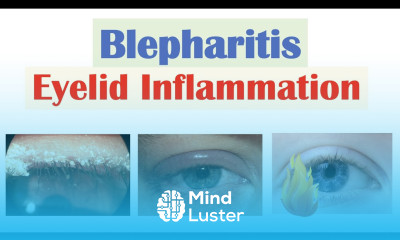 Blepharitis Eyelid Inflammation Causes Risk Factors Signs Symptoms Diagnosis Treatment