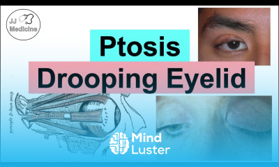 Ptosis Drooping Eyelid Eye Anatomy Causes Associated Conditions Diagnosis Treatment