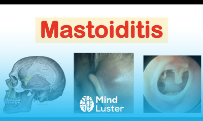 Learn Mastoiditis Acute Otitis Media Causes Pathophysiology Symptoms ...