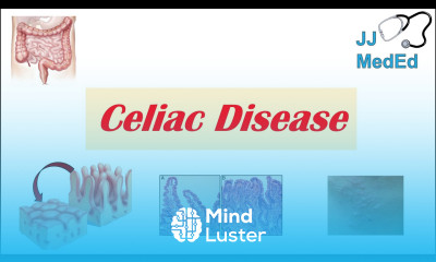 Celiac Disease Gluten Sensitivity Risk Factors Pathogenesis Symptoms Diagnosis Treatment