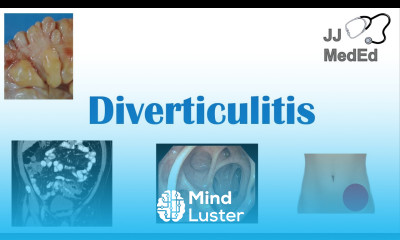 Diverticulitis Risk Factors ex Low Fiber Diets Symptoms Diagnosis Treatment and Complications