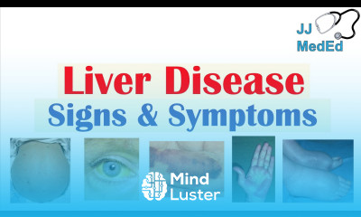Liver Disease Signs Symptoms ex gynecomastia bruising Hepatic Stigmata