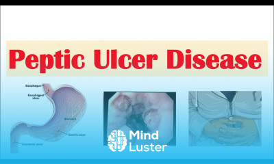 Peptic Ulcer Disease Gastric vs Duodenal Ulcers Causes Symptoms Diagnosis Treatment