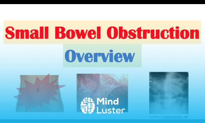 Small Bowel Obstruction SBO Risk Factors Causes Signs Symptoms Diagnosis Treatment