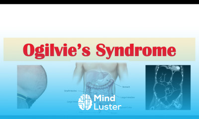 Ogilvie Syndrome Pseudo Obstruction of the Large Intestine Causes Symptoms Diagnosis Treatment