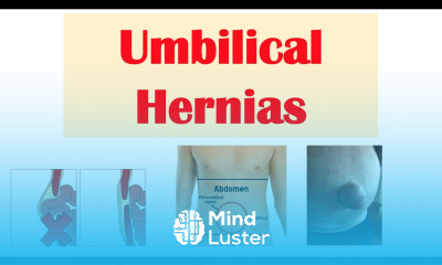 Umbilical Hernia Belly Button Hernia Risk Factors Signs and Symptoms Diagnosis Treatment