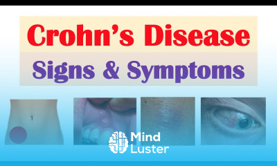 Crohn s Disease Signs and Symptoms Why They Occur and Complications Deficiencies