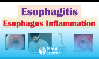 Esophagitis Esophagus Inflammation Causes Risk Factors Signs and Symptoms Diagnosis Treatment