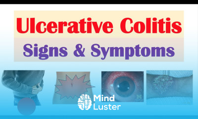 Ulcerative Colitis Signs and Symptoms Why They Occur and Complications