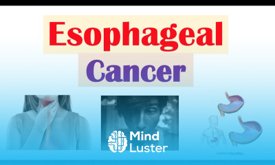 Esophageal Cancer Risk Factors Pathogenesis Signs and Symptoms Diagnosis Treatment