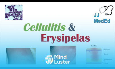 Cellulitis vs Erysipelas Bacterial Causes Risk Factors Signs and Symptoms Treatment