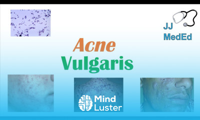 Acne Vulgaris Causes Pathogenesis Influencing Factors Diagnosis Treatment and Complications