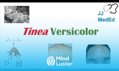 “Fungal Skin Infection of Many Colors” Tinea Versicolor Pathogenesis Symptoms and Treatment
